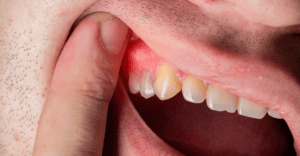 Abscessed Tooth Treatment