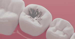 Broken Dental Filling