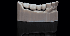 Emergency Dental Bridges in Cincinnati