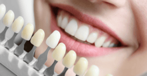 Teeth Whitening