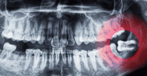Wisdom Teeth