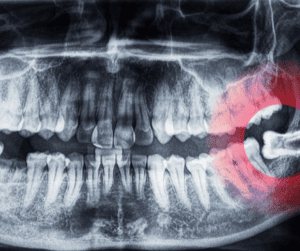Wisdom Teeth Removal in Cincinnati