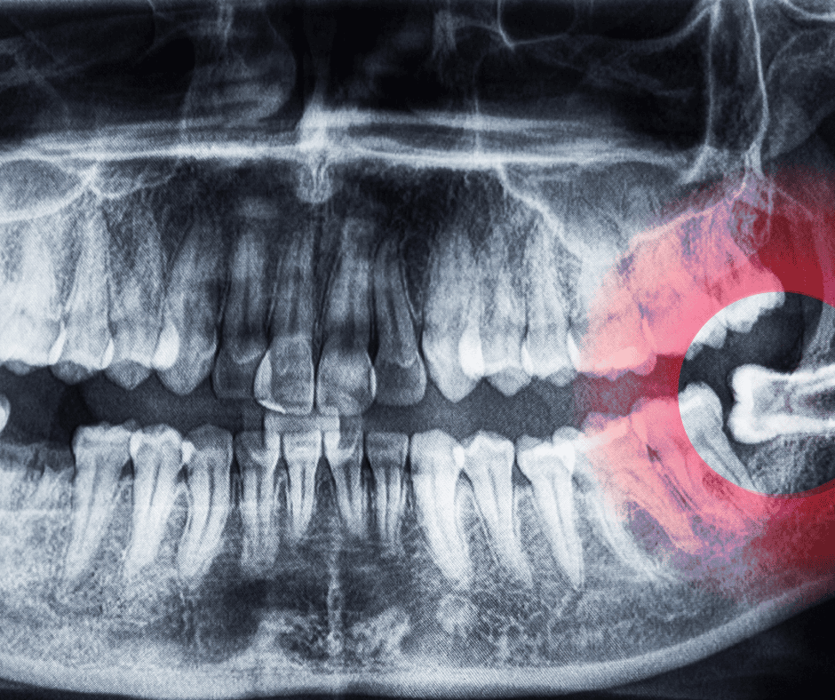 What Happens If You Don’t Remove Your Wisdom Teeth? Three Things to Consider